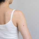 腕にイボがある女性
