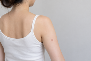 腕にイボがある女性